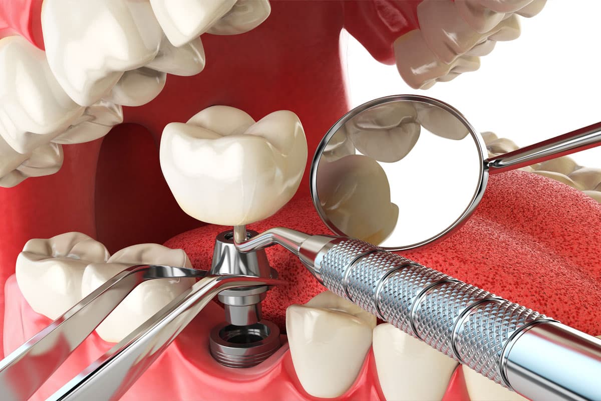 Poner un implante dental en O Grove